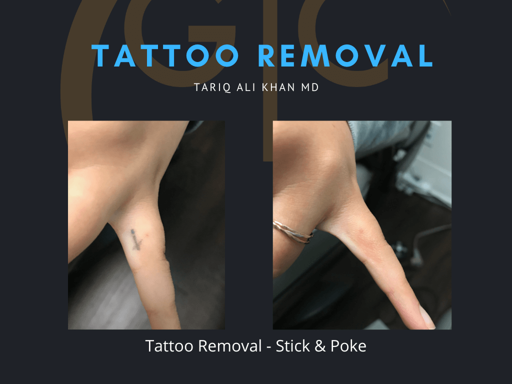 Gentle Care Laser Tustin & Long Beach CA Before and After picture - Tattoo Removal